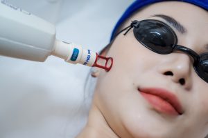 A patient is getting the melasma laser treatment