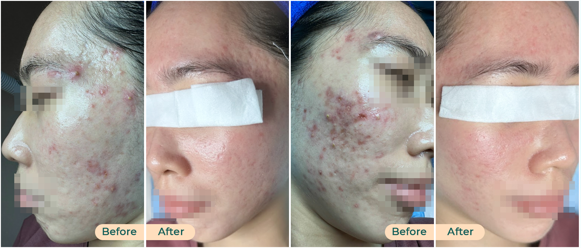 BEFORE - AFTER PROFESSIONAL ACNE TREATMENT