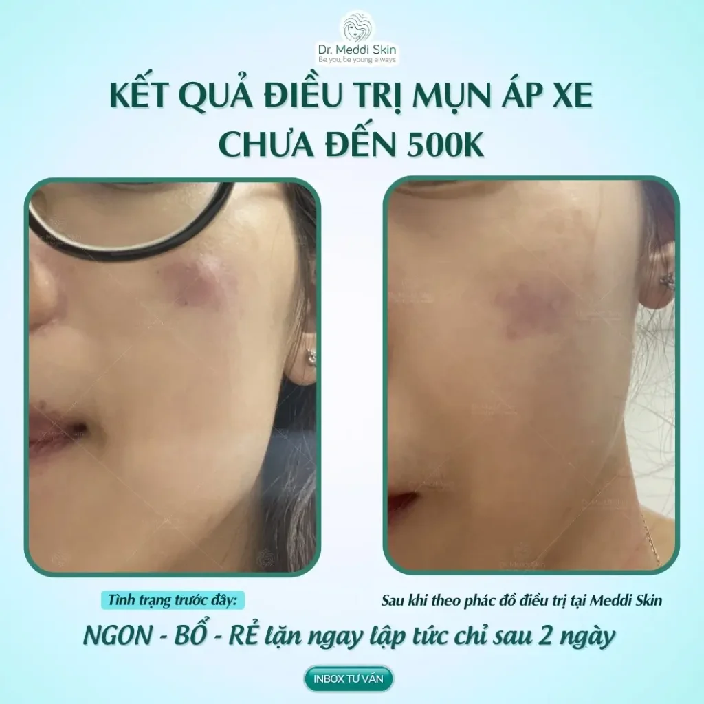 KẾT QUẢ ĐIỀU TRỊ MỤN ÁP XE CỦA CÔ BẠN KHÁNH VÕ - CHƯA ĐẾN 500K