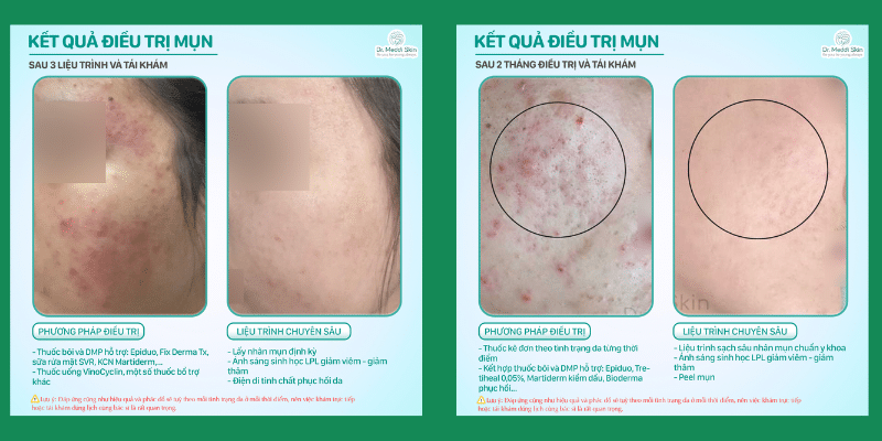 before-after-using-advanced-laser-in-acne-treatment-in-wedo-skinclinic-2