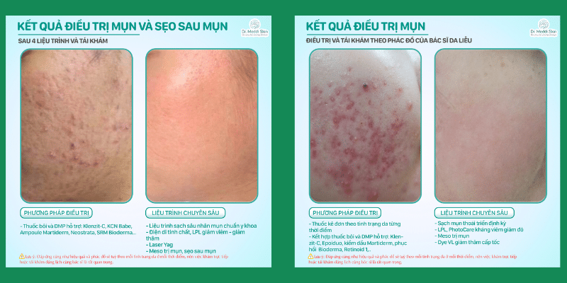 before-after-using-advanced-laser-in-acne-treatment-in-wedo-skinclinic-3