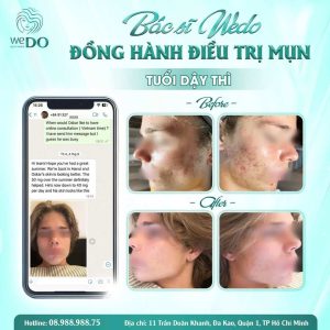 Bác sĩ đồng hành cùng bạn nhỏ Oscar loại sạch mụn - thâm tuổi dậy thì | Oscar once struggled with stubborn whiteheads, cystic acne, and persistent acne scars.