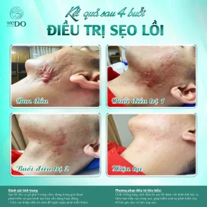 Remove keloid scars in just 4 sessions with a 600k