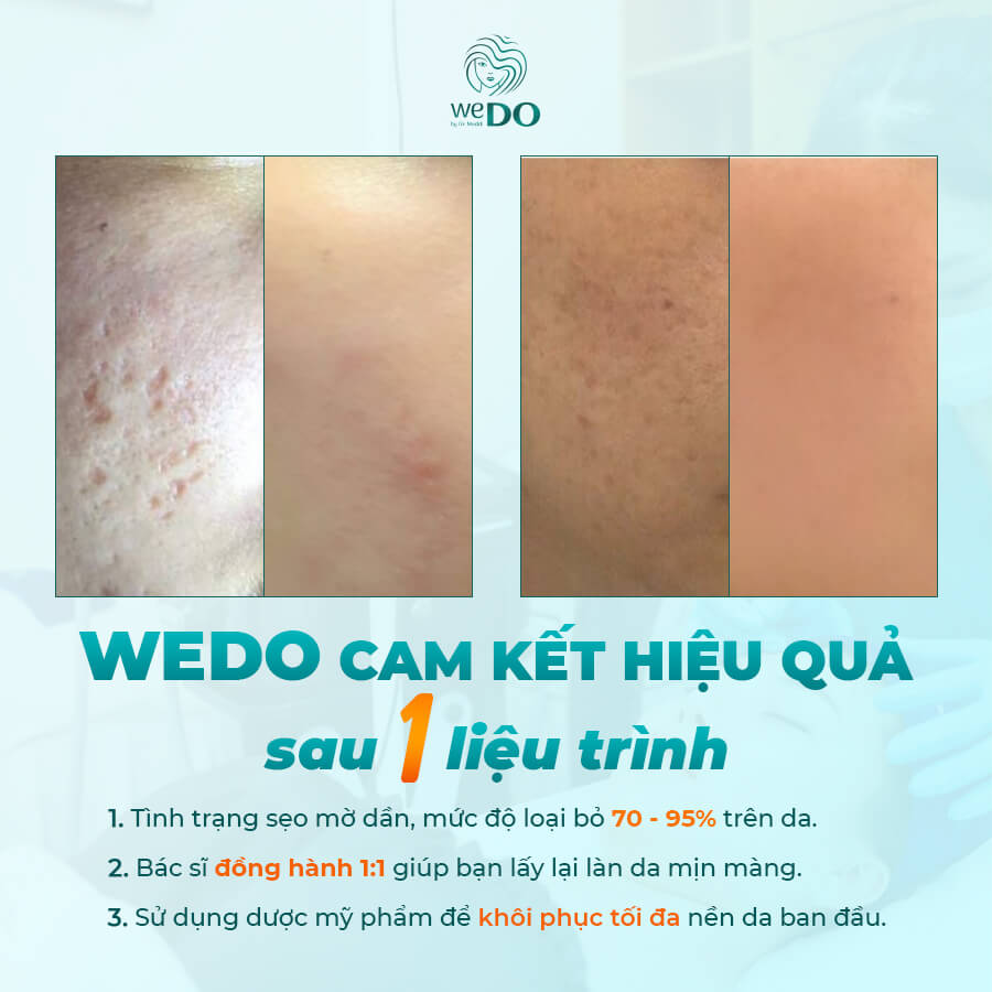 COME TO WEDO - YOUR SOLUTION TO ALL SCAR CONCERNS