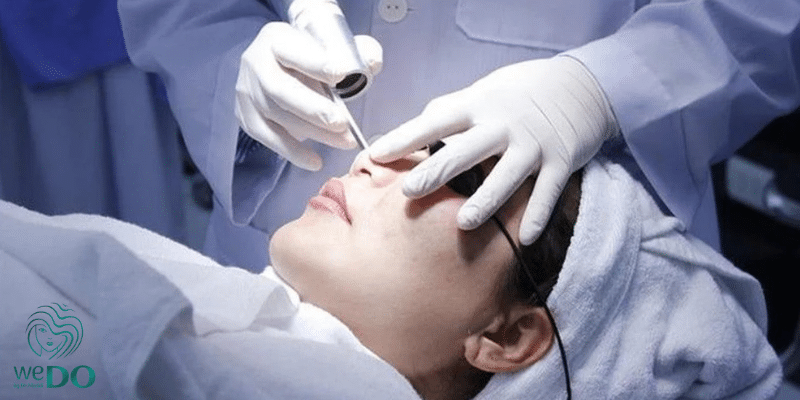 why-should-you-use-advanced-laser-acne-treatment-1