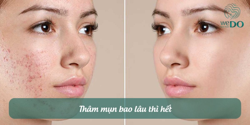 Thâm mụn bao lâu thì hết