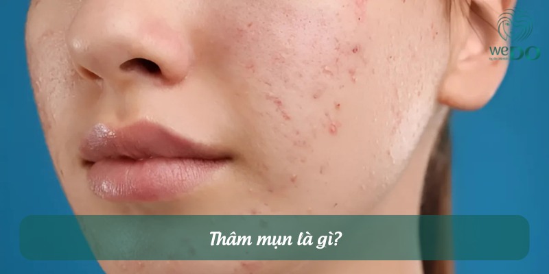 Thâm mụn là gì?