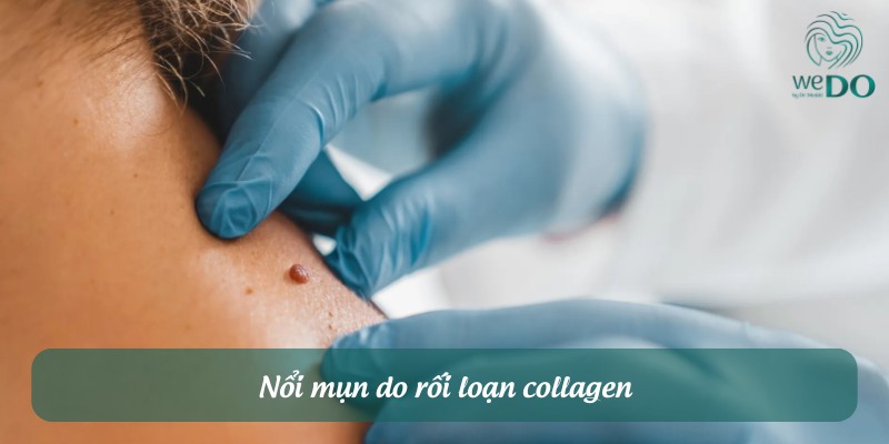 Nổi mụn thịt do rối loạn collagen