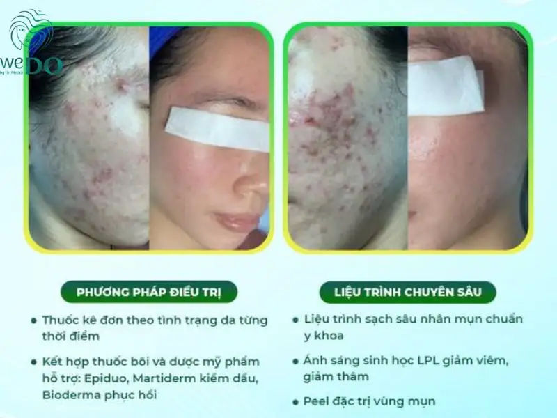 Giá Trị Mụn Cóc HCM Bao Nhiêu? Cập Nhật Chi Phí & Cách Điều Trị Hiệu Quả