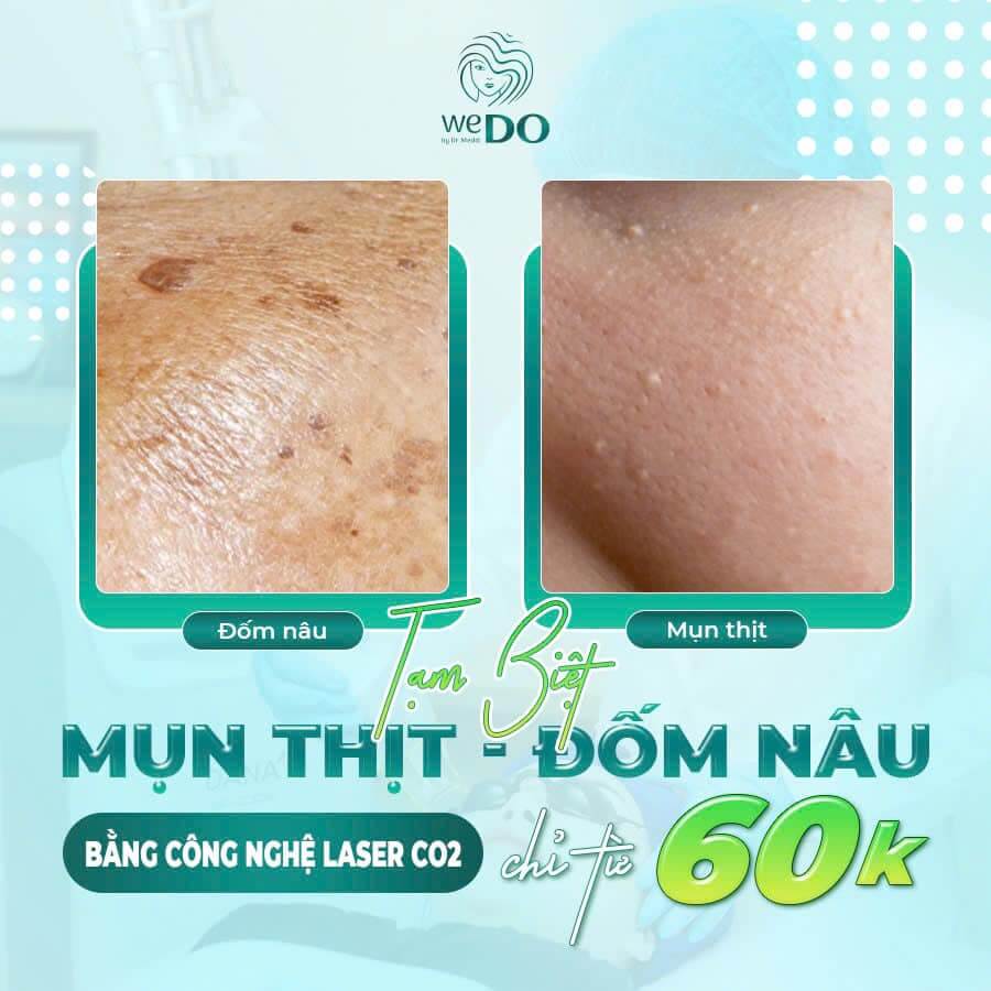 TẠM BIỆT MỤN THỊT/ ĐỐM NÂU CHỈ TỪ 60K!