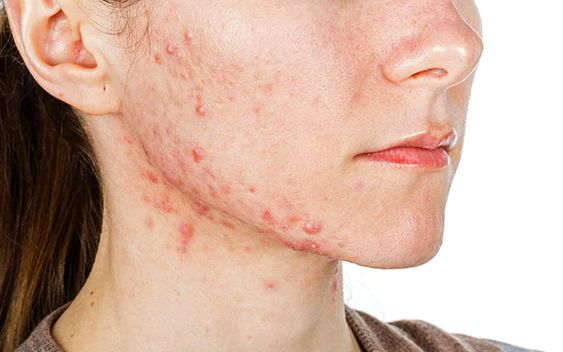 MEDICAL ACNE TREATMENT