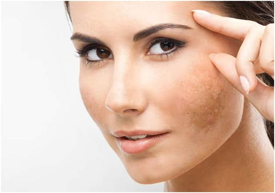 MELASMA TREATMENT – FRECKLES & DARK SPOTS REMOVAL