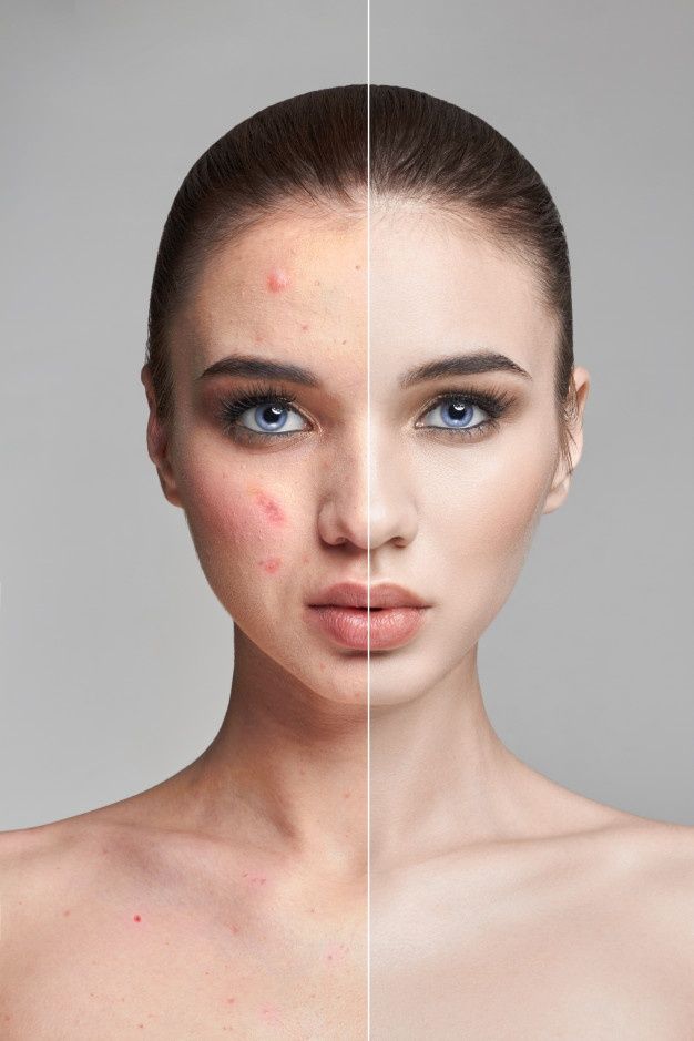 Does Acne Extraction Cause Scars?