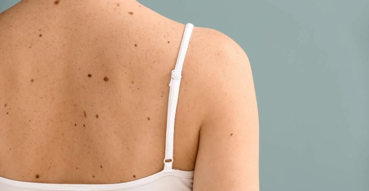 Skin Growths 101: Why Do Moles, Warts, Skin Tags, & Milia Appear?