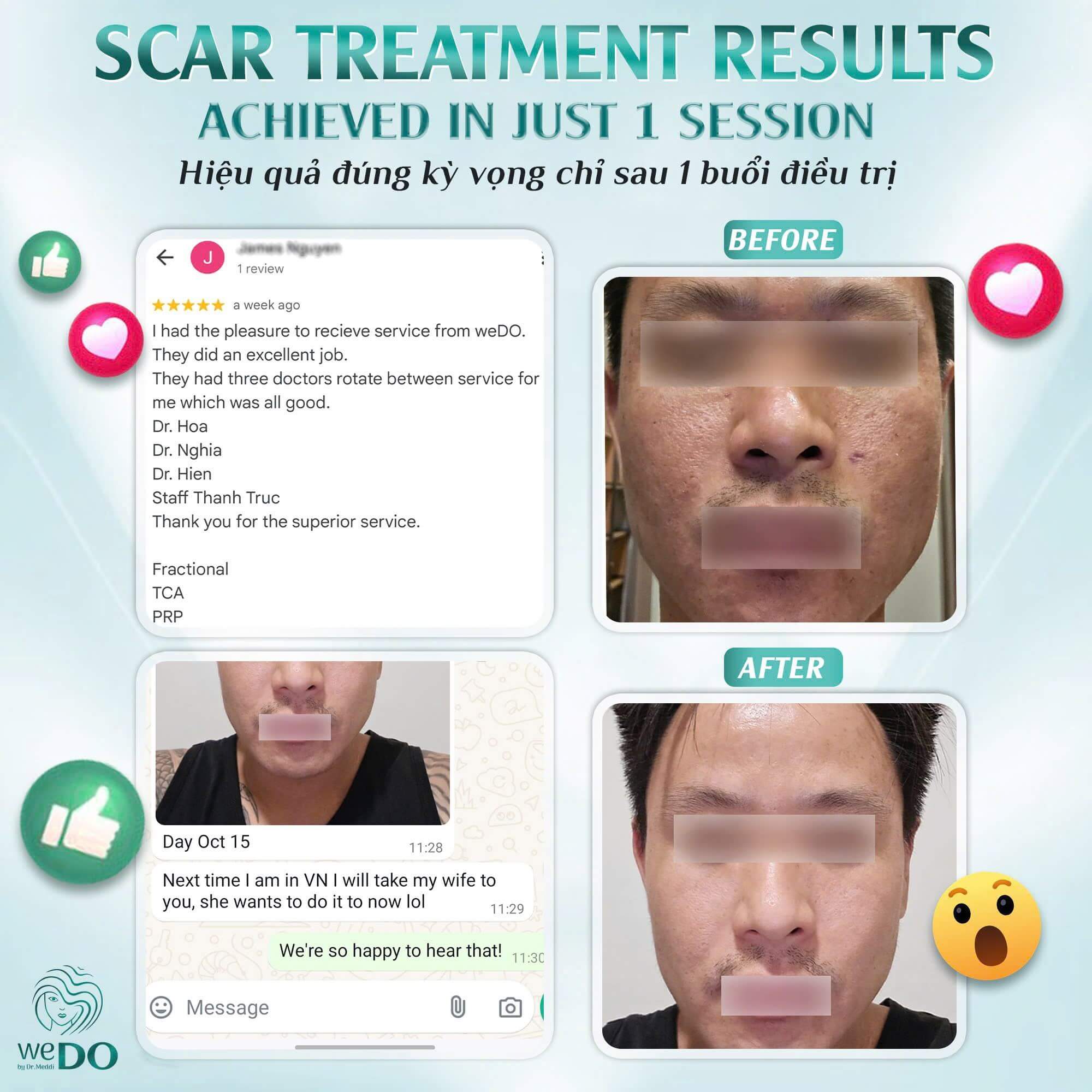 Only 1 SESSION – 1 TREATMENT to treat pitted scars – James Nguyen – Overseas Vietnamese guy got the expected results right away! 🥰