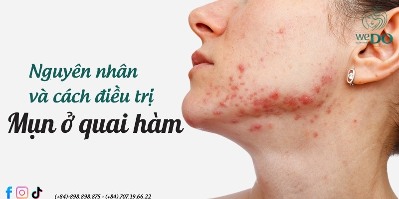 Mụn ở quai hàm – Đặc điểm, nguyên nhân và bí quyết sạch mụn