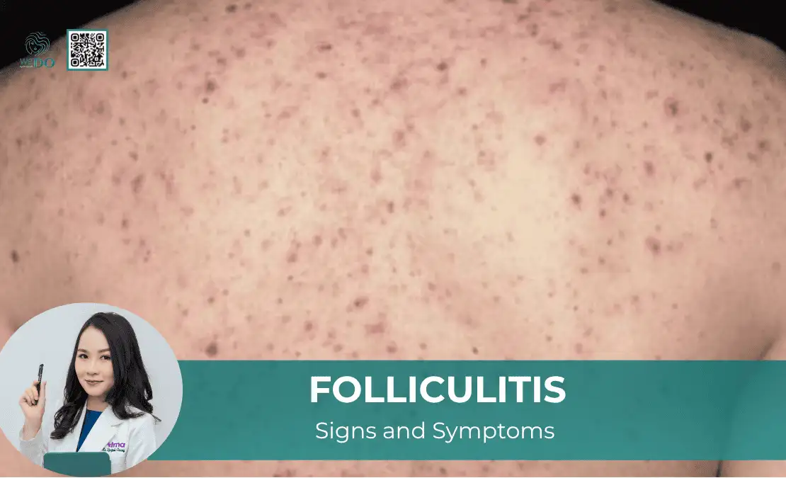 WHAT IS FOLLICULITIS AND HOW IS IT TREATED?