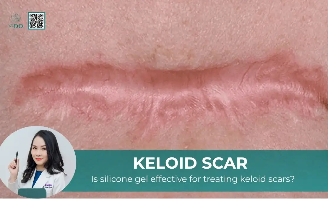 Is silicone gel effective for treating keloid scars?